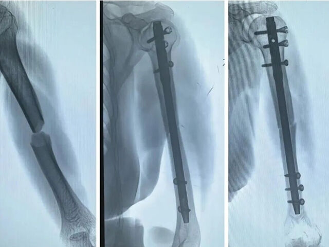 Perform humeral intramedullary nailing according to AO principles