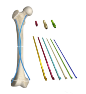 Klinische Anwendung von elastischen intramedullären Nadeln in der Behandlung von Kindern