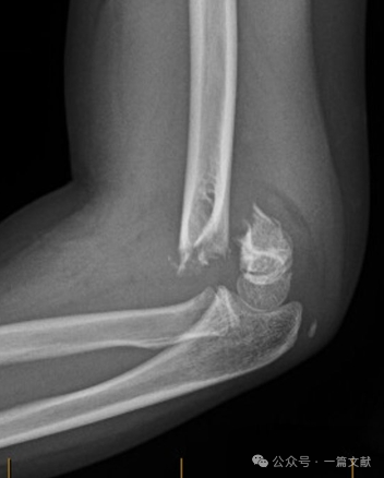 Treatment of Pediatric Supracondylar Humerus Fractures