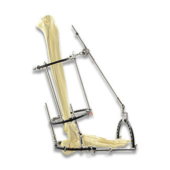 Ring External Fixator