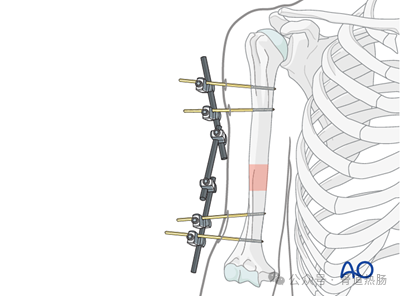 External fixation（Simple humeral shaft fracture, spiral fracture.）