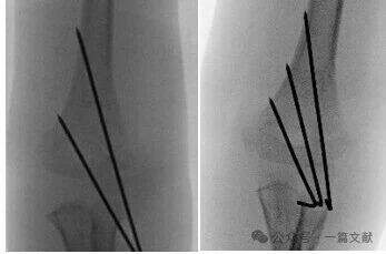 Treatment of Pediatric Supracondylar Humerus Fractures