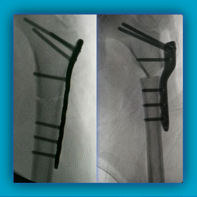 Pediatric Proximal Femoral Osteotomy