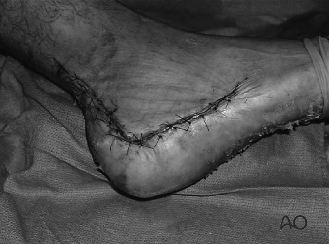 The Extended Lateral Approach to the Calcaneus – The Large L-Shaped Incision