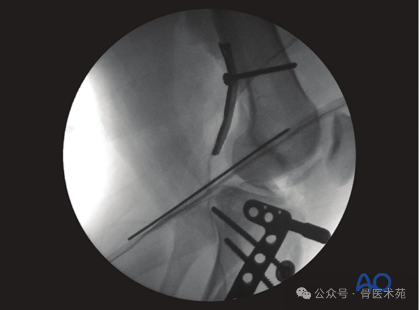 Open Reduction and Internal Fixation with Plate for Hoffa Fracture