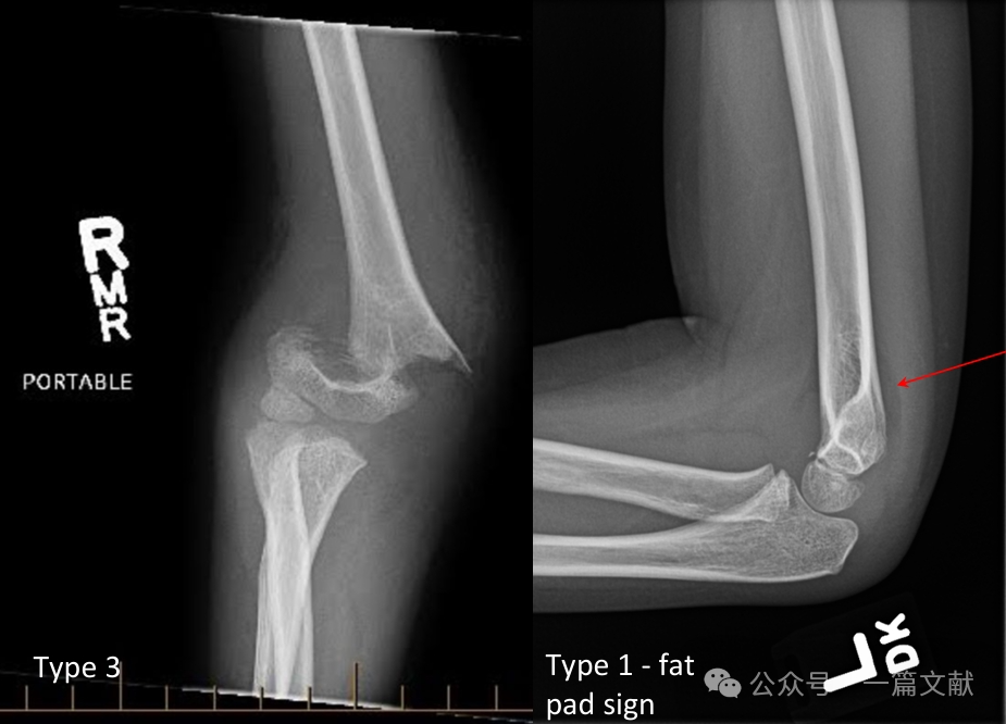 Treatment of Pediatric Supracondylar Humerus Fractures