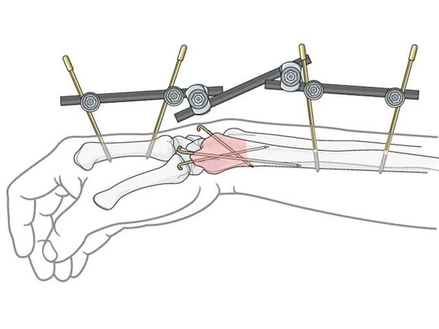 Transarticular External Fixation for Distal Radius Fractures