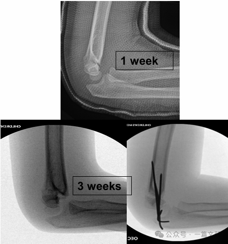 Treatment of Pediatric Supracondylar Humerus Fractures