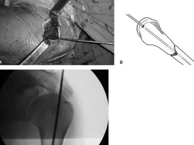 Indikationer och kirurgiska tekniker för intramedullär navelbehandling av extremitetsfrakturer