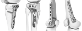 Placă de blocare HTO: O soluție precisă și stabilă pentru osteotomia înaltă a articulației genunchiului