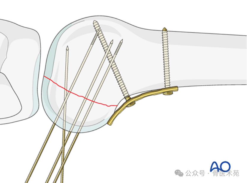 Open Reduction and Internal Fixation with Plate for Hoffa Fracture