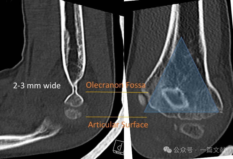 Treatment of Pediatric Supracondylar Humerus Fractures