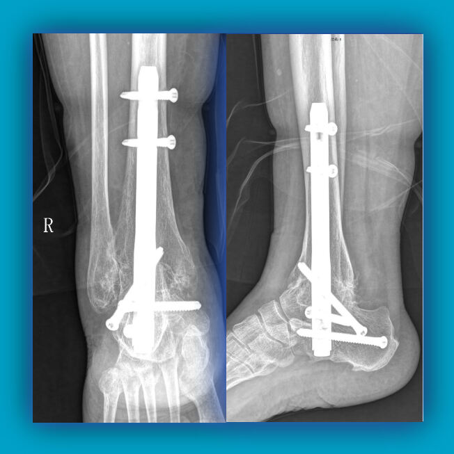 Ankle Arthrodesis