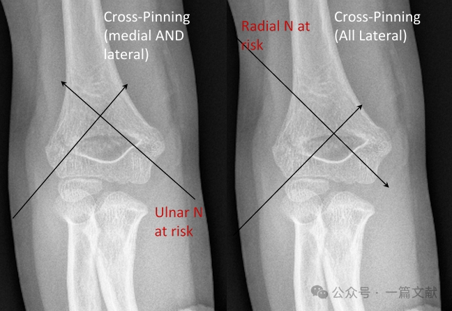 Treatment of Pediatric Supracondylar Humerus Fractures