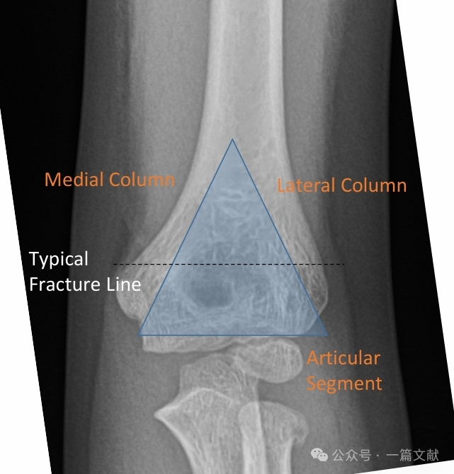 Treatment of Pediatric Supracondylar Humerus Fractures
