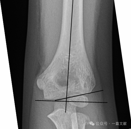 treatment of pediatric supracondylar humerus fractures ota core curriculum-1