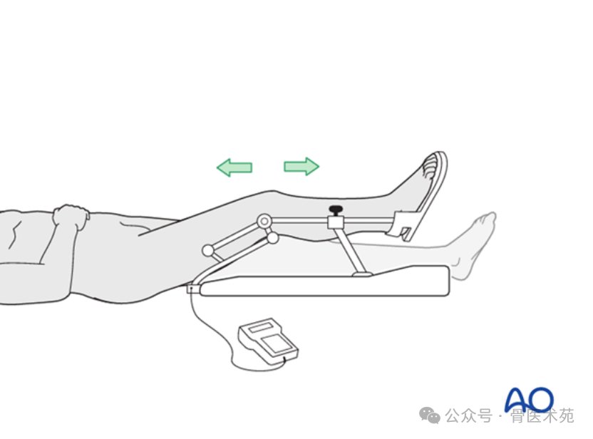 Open Reduction and Internal Fixation with Plate for Hoffa Fracture