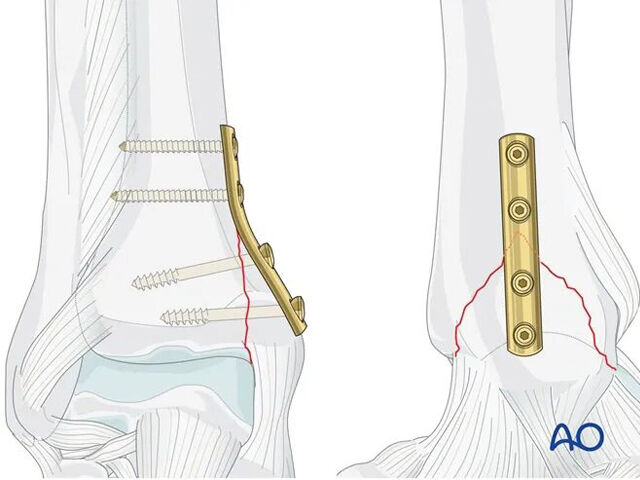 AO-standardteknik: Fixering med stödplatta för frakturer av mediala malleolen