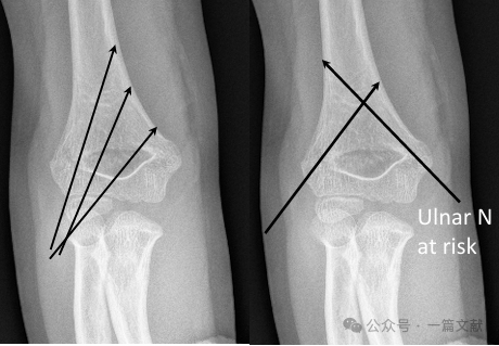 Treatment of Pediatric Supracondylar Humerus Fractures