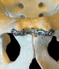 Premium Biocompatible Materials for Long-Term Performance