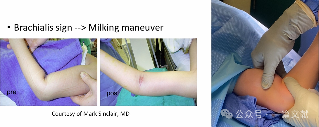 Treatment of Pediatric Supracondylar Humerus Fractures