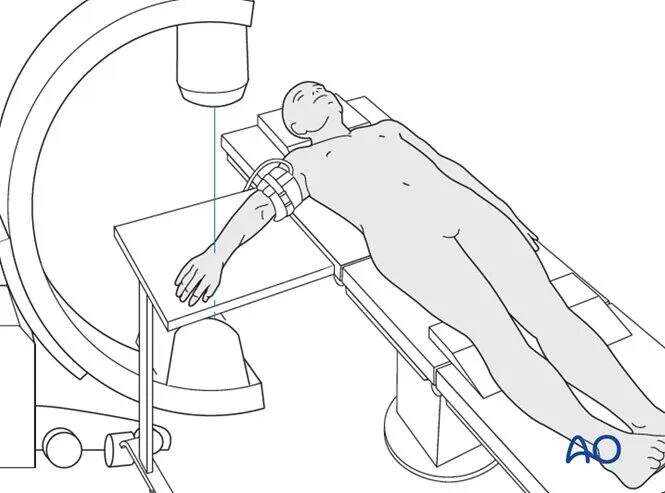 transarticular external fixation for distal radius fractures-2