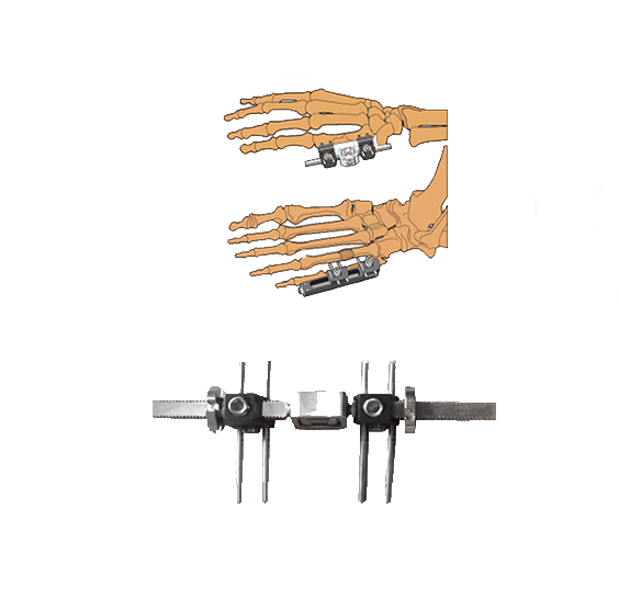 Enhanced Soft Tissue Management