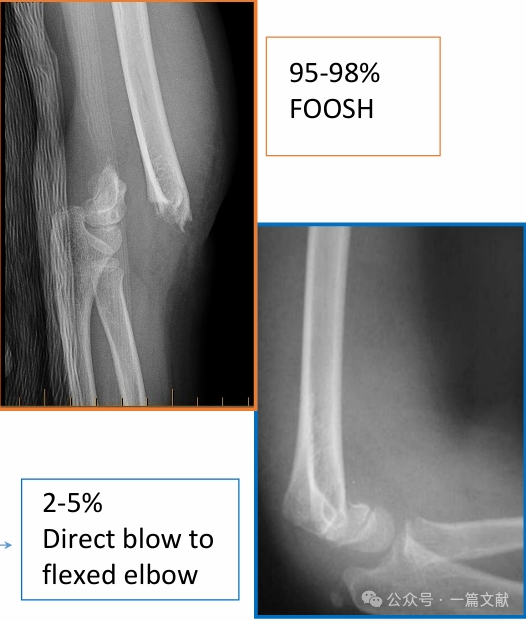Treatment of Pediatric Supracondylar Humerus Fractures
