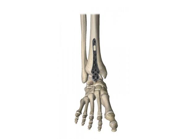 Anatomically Optimized Design for Superior Fit