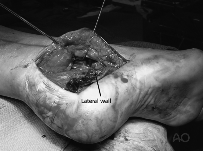 The Extended Lateral Approach to the Calcaneus – The Large L-Shaped Incision