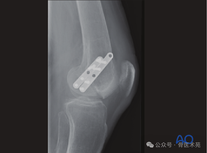 Open Reduction and Internal Fixation with Plate for Hoffa Fracture