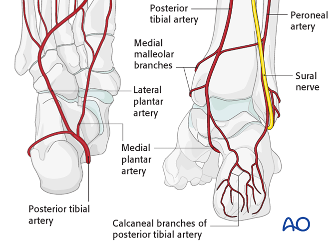 The Extended Lateral Approach to the Calcaneus – The Large L-Shaped Incision