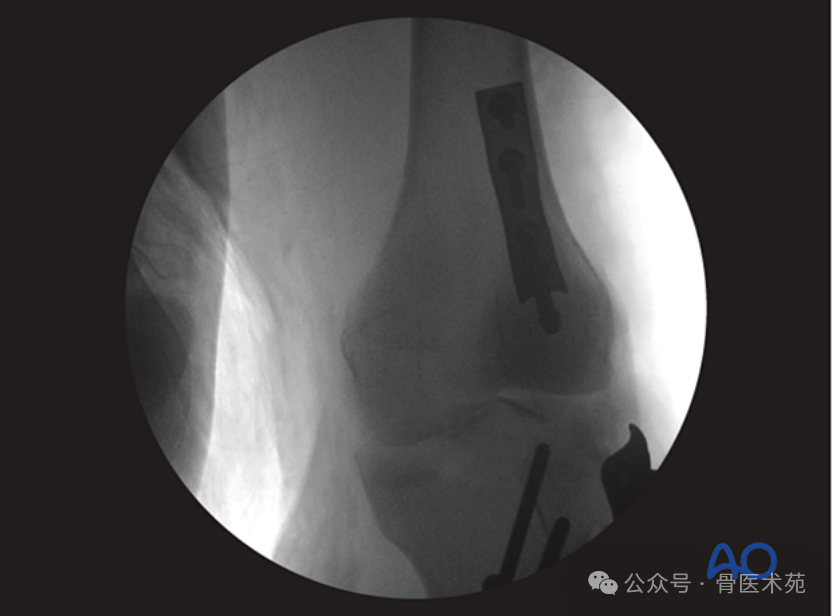 Open Reduction and Internal Fixation with Plate for Hoffa Fracture