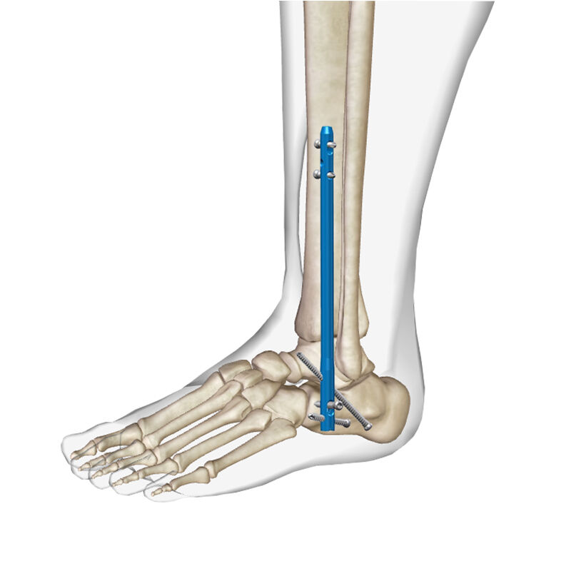 Application analysis of intramedullary nail system in ankle joint fusion