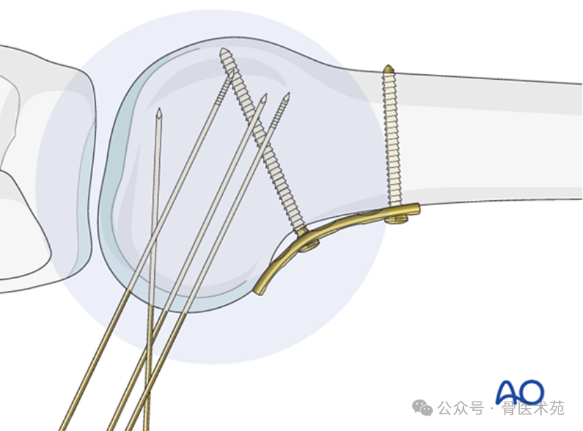 Open Reduction and Internal Fixation with Plate for Hoffa Fracture