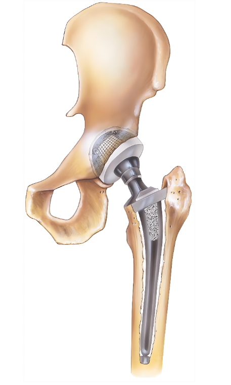Precision Engineering for Optimal Implant Positioning