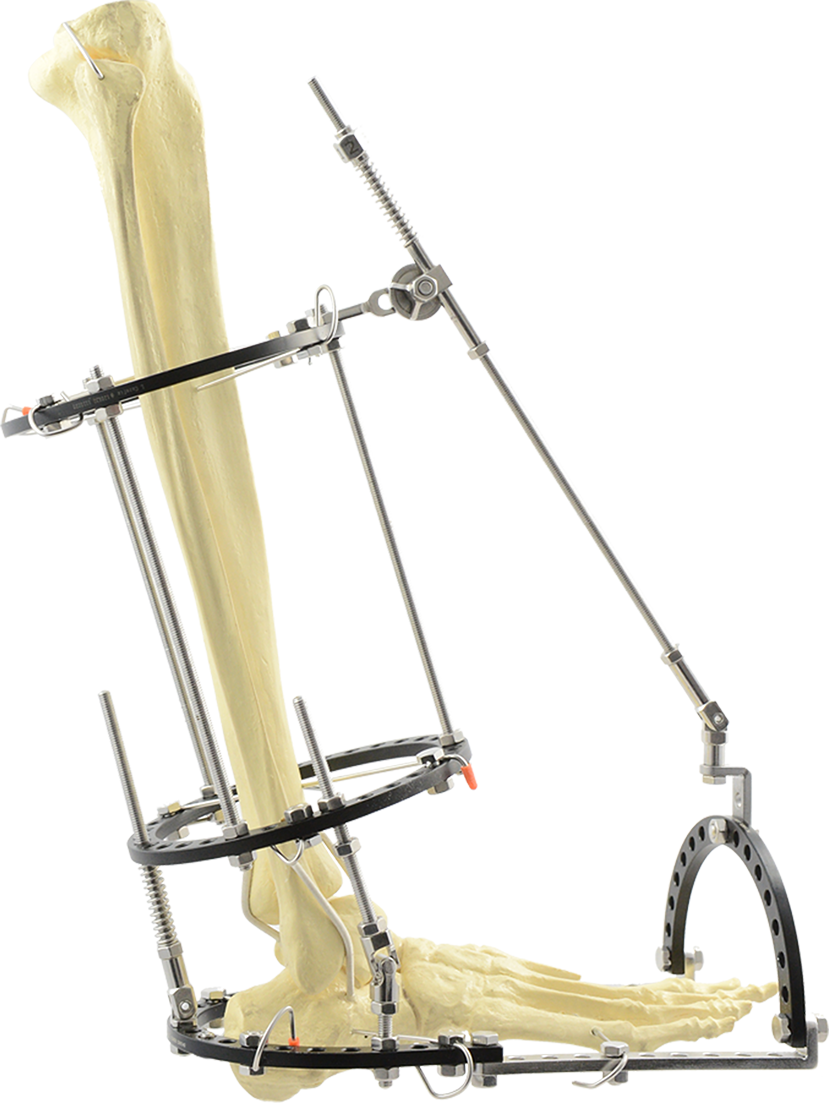 Immediate Stabilization with Minimal Tissue Disruption