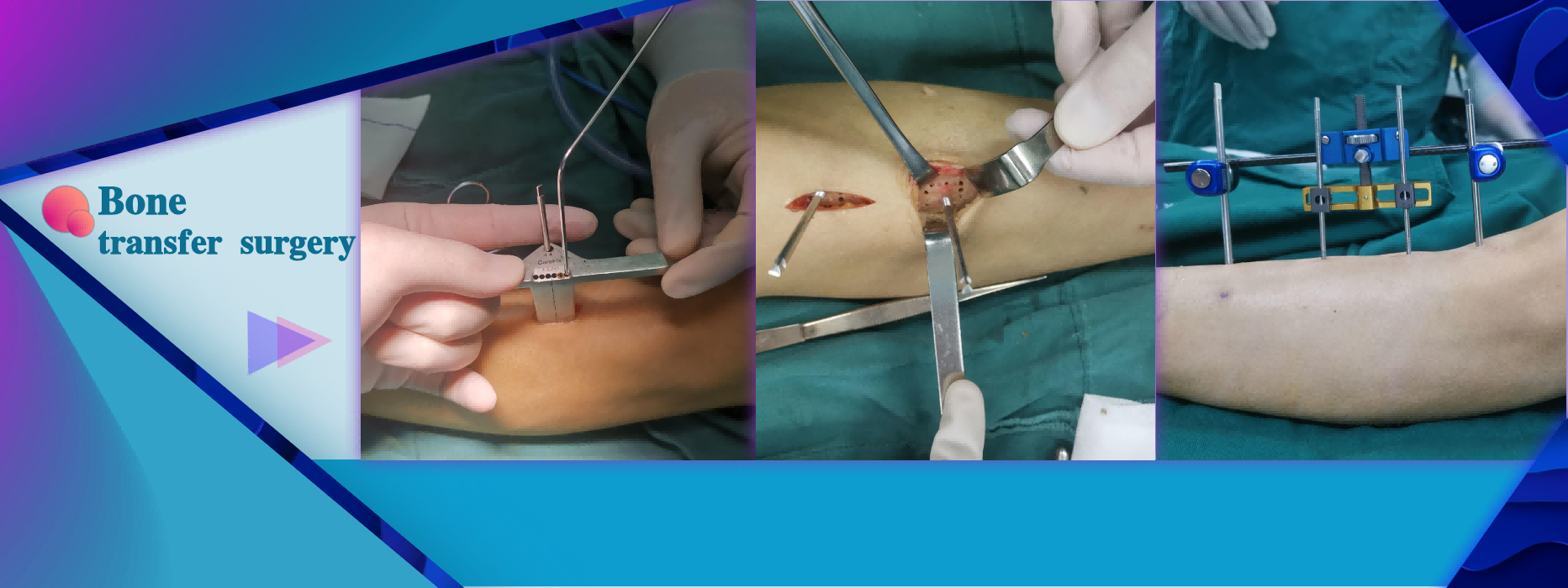 Lateral Tibial Bone Transfer Surgery