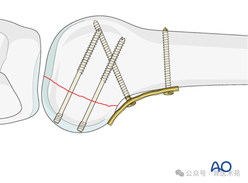 Open Reduction and Internal Fixation with Plate for Hoffa Fracture