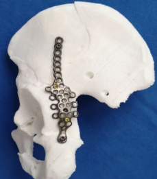 Versatile Fixation Options for Complex Cases