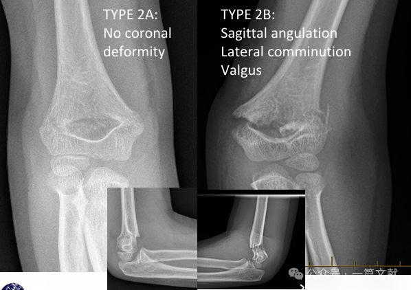 Treatment of Pediatric Supracondylar Humerus Fractures