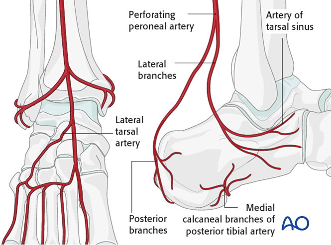 The Extended Lateral Approach to the Calcaneus – The Large L-Shaped Incision