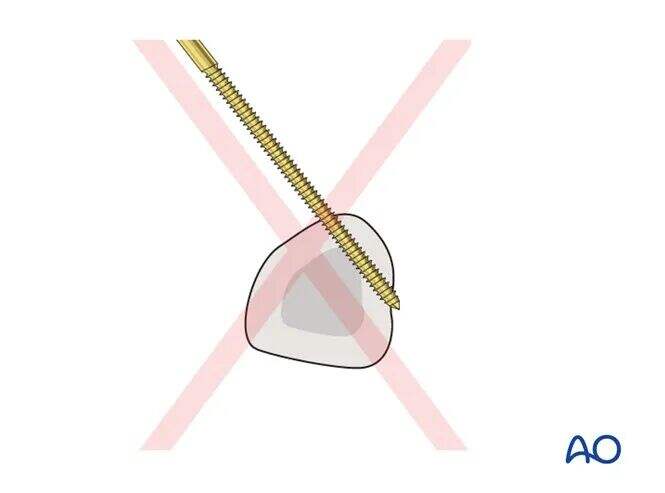 Transarticular External Fixation for Distal Radius Fractures