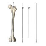 No need for secondary surgery: How does the self-lengthening intramedullary nail synchronize with bone development?