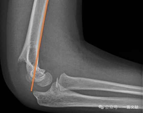 treatment of pediatric supracondylar humerus fractures ota core curriculum-2