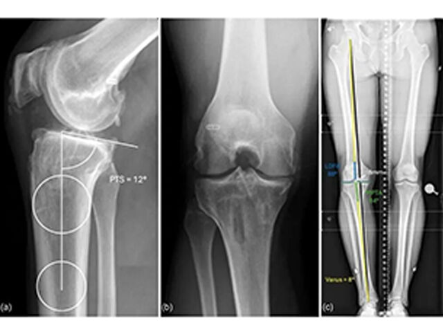 Tehnični nasveti in triki za zapleteno biplanarno visoko tibialno osteotomijo