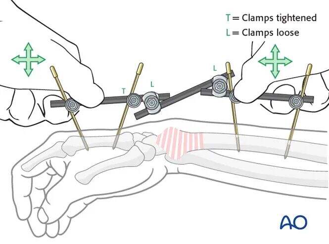 Transarticular External Fixation for Distal Radius Fractures