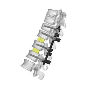 Spinal Fixation