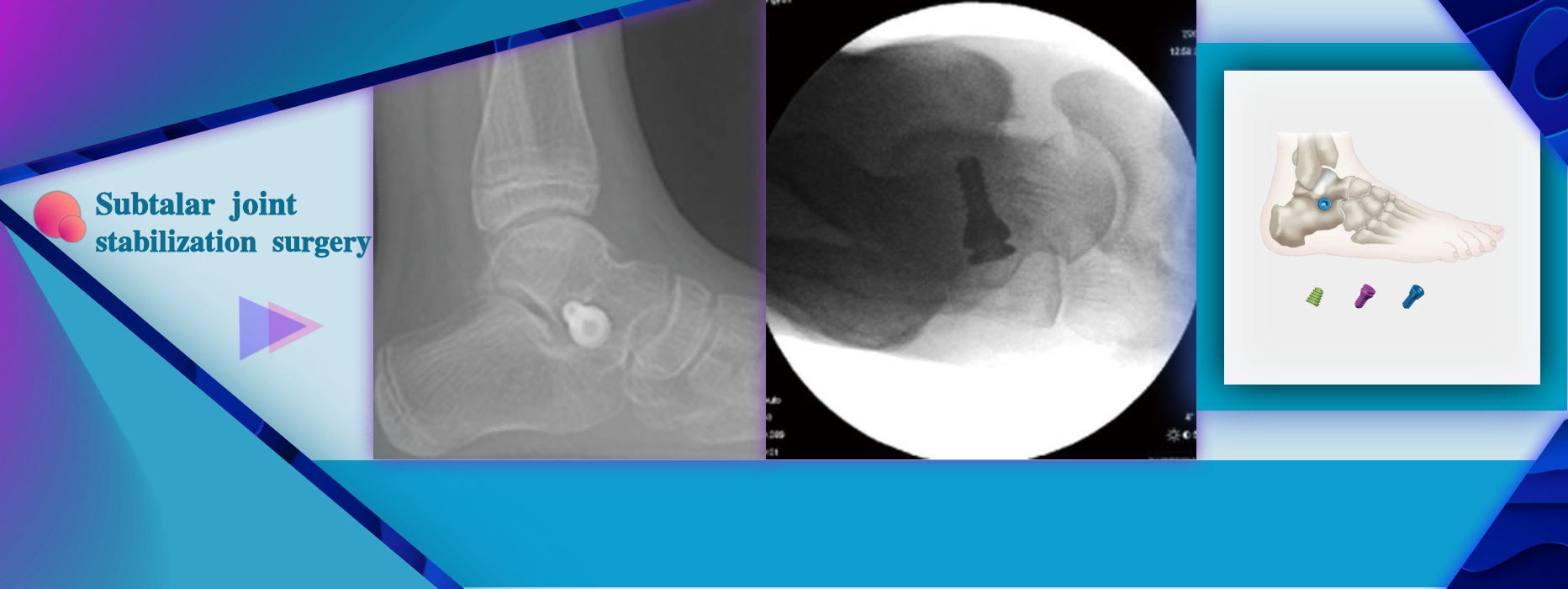 Subcalar Joint Immobilization Surgery