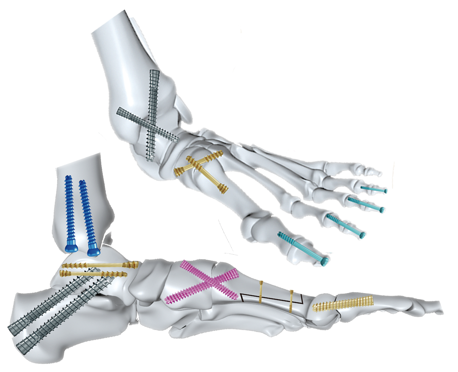 Enhanced Clamping Performance for Stronger Joints